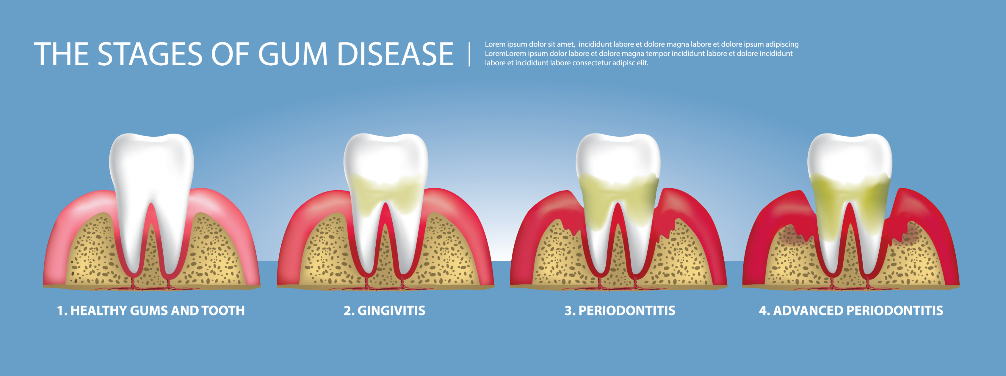 Gum Treatment