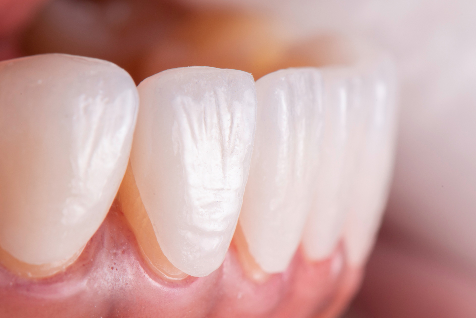 Generally, there are 2 types of veneers available: