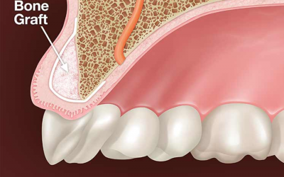 Bone Graft