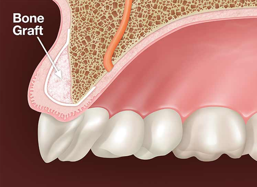 Bone Graft