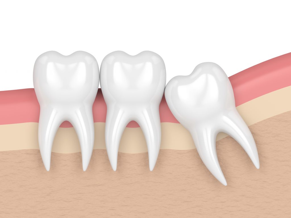 Mesial impaction