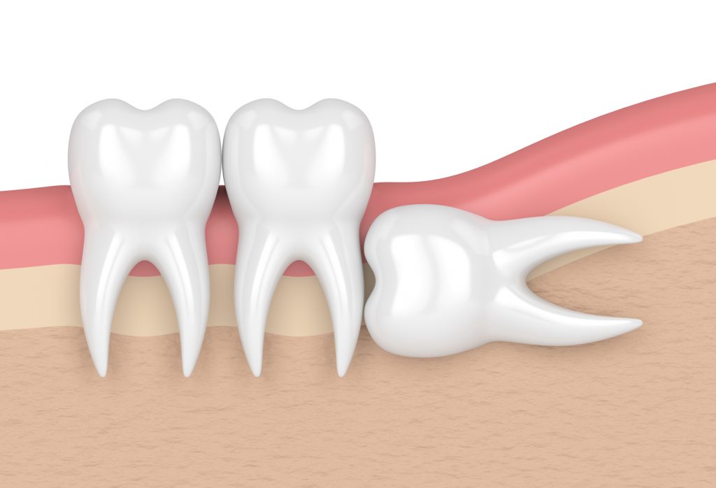 Horizontal impaction