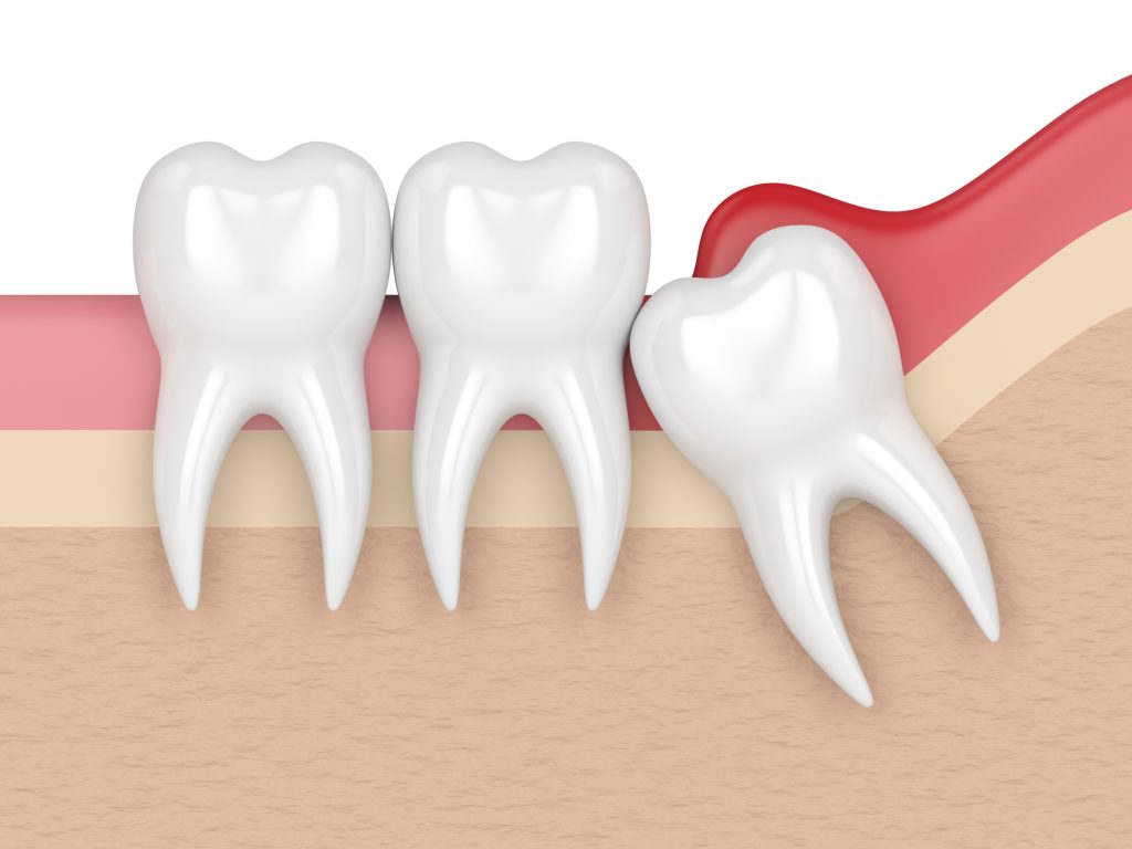 Mesial impaction with pericoronitis