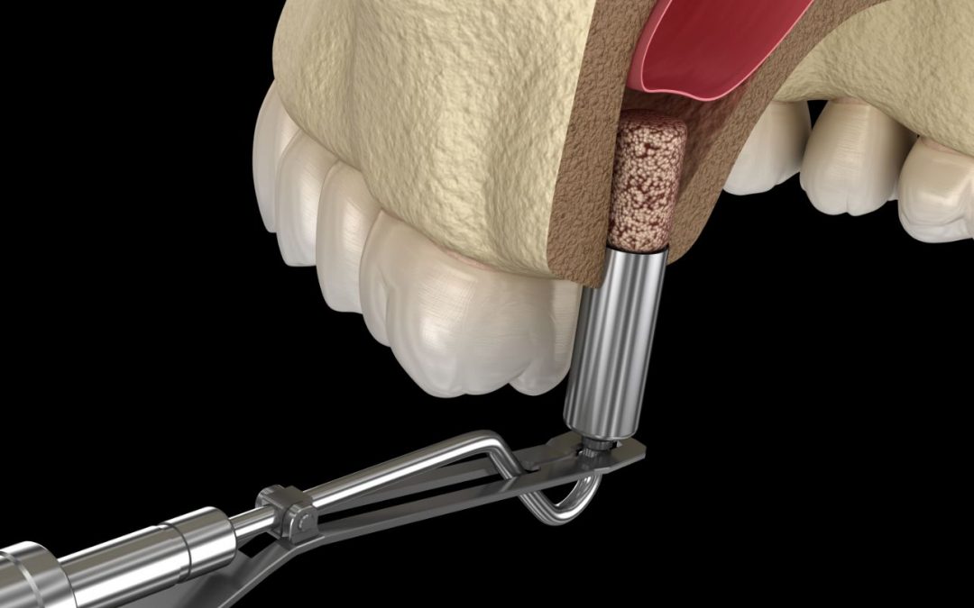 Sinus Lift