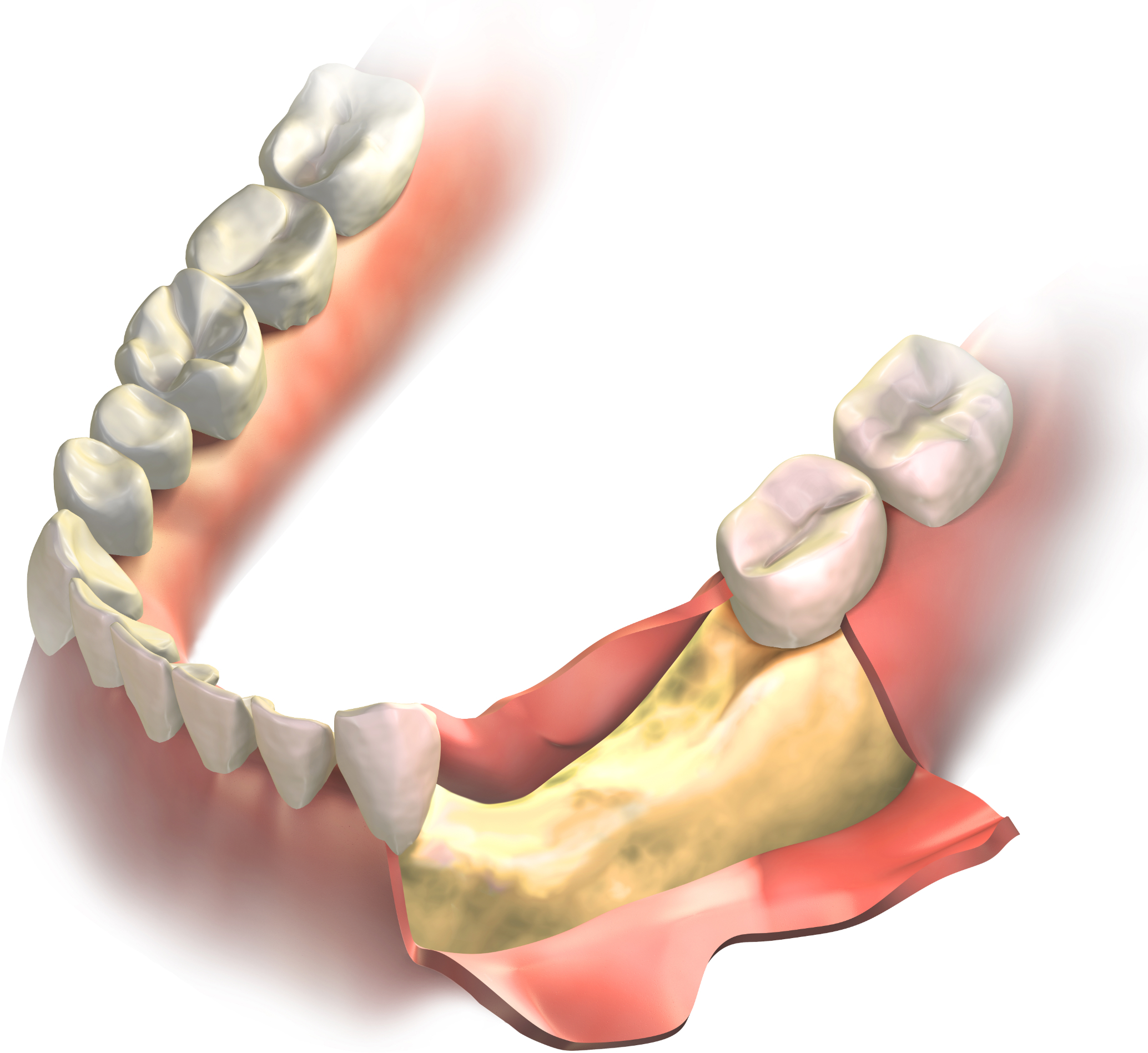 Bone loss on lower jaw (gums opened to expose bone before grafting surgery)