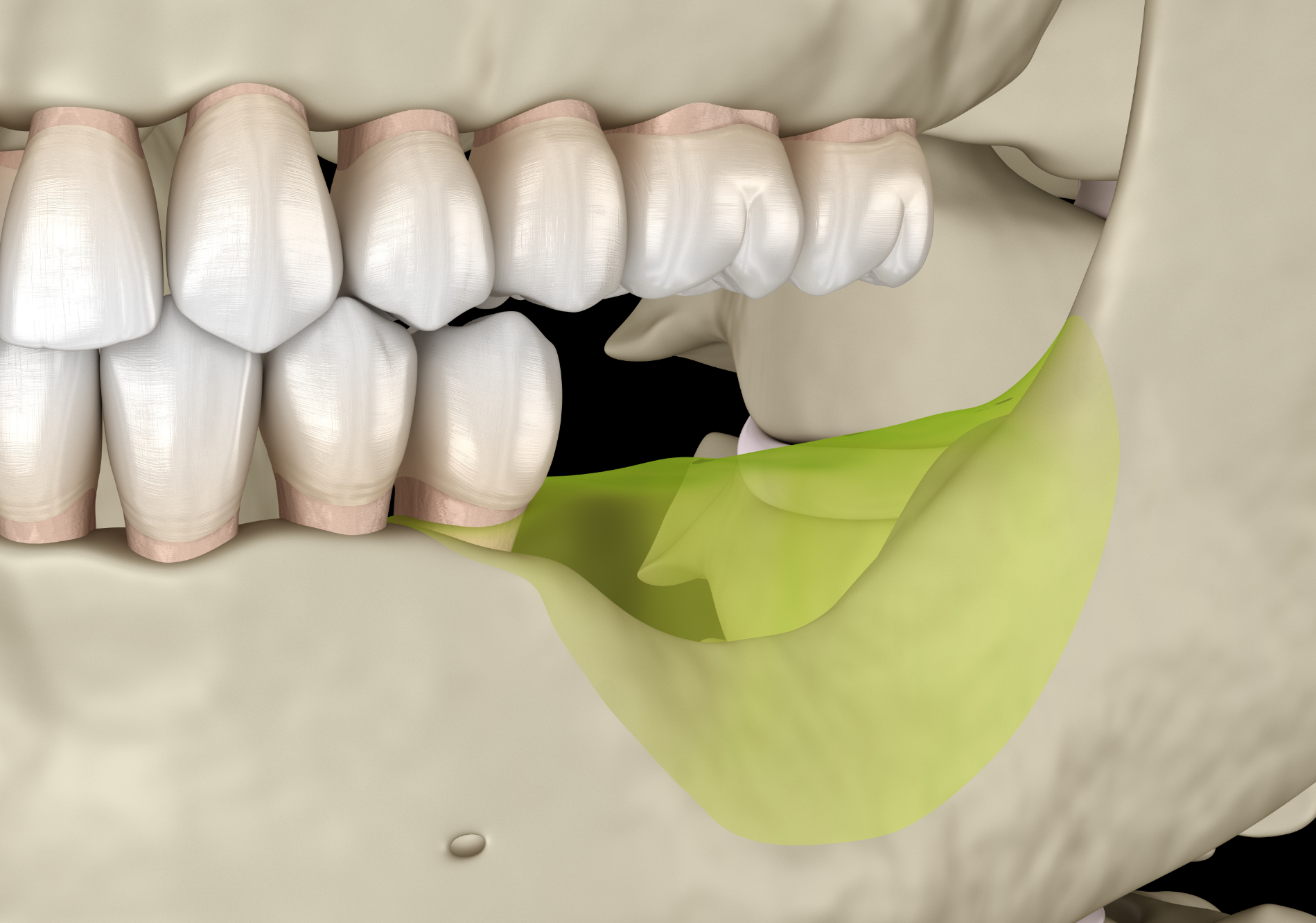 Bone is living tissue. At any one time, our body is forming new bone and removing existing bone in a constant process of bone remodelling. Our jawbones are strengthened by physical stimulus such as the biting and chewing forces transmitted through the teeth. When we lose our teeth, the physical stimulus is lost over the affected area, bone is resorbed and shrinkage occurs. Bone loss may also occur due to systemic conditions such as osteoporosis. 