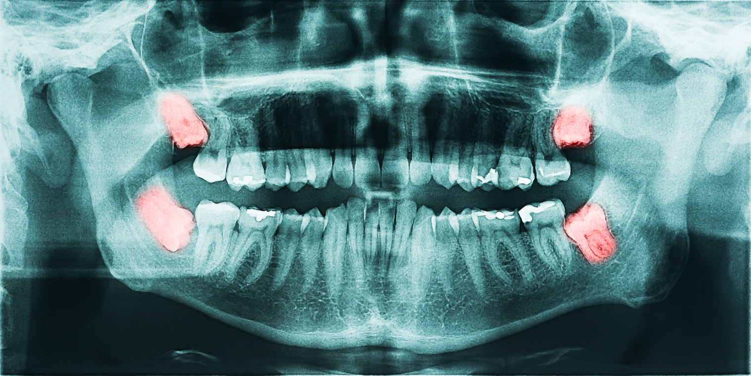 Wisdom Tooth Removal