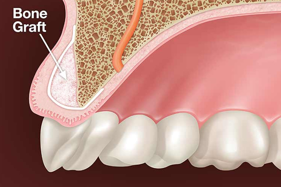 Bone Graft